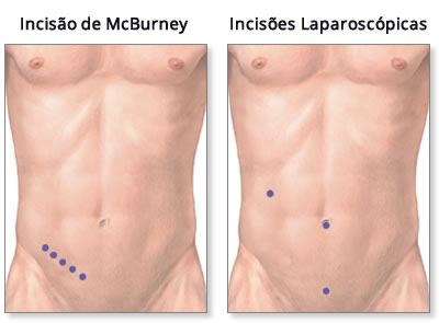 Incisão de McBurney Apendicectomia