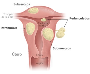 Mioma Uterino