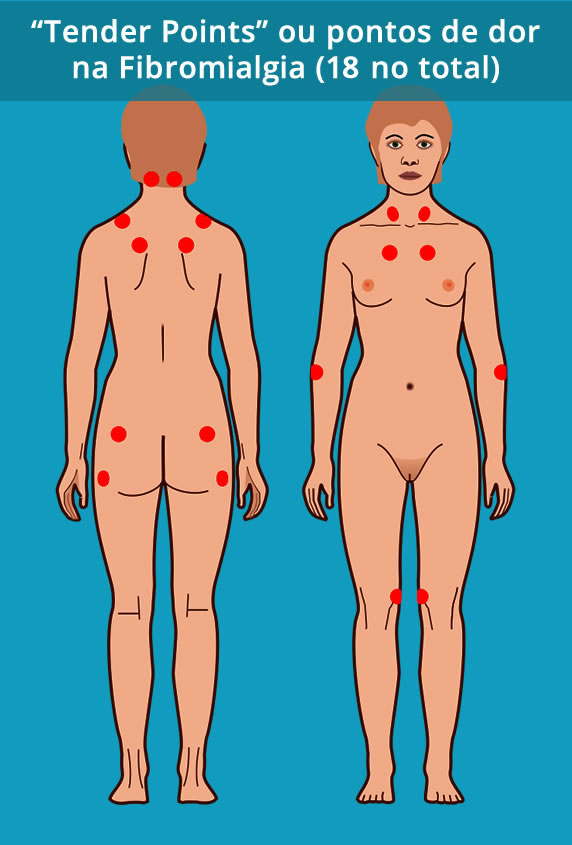 Posição dos pontos dolorosos da Fibromialgia pelos critérios de 1990 da ACR